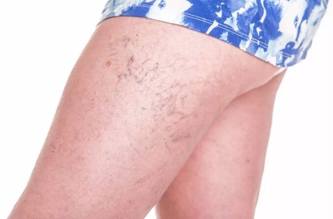 Malla vascular en las piernas