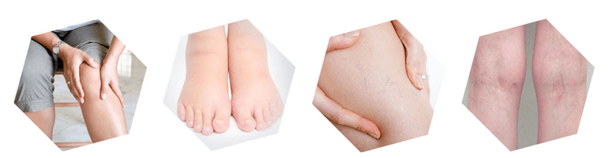 Varices