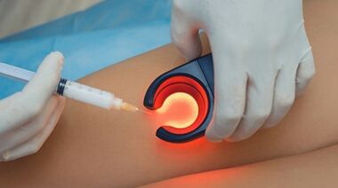 Terapia de venosclerosis para venas varicosas