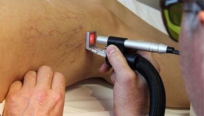 Tratamiento con láser de venas varicosas